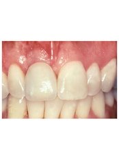 Dental Implants - Dr. Luiz Alberto Ferraz de Caldas