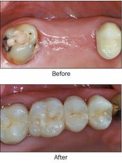 Dental Bridges - Dr. Luiz Alberto Ferraz de Caldas