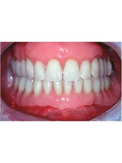 Full Dentures - Dr. Luiz Alberto Ferraz de Caldas