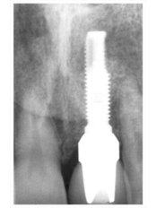 Implant Dentist Consultation - Dr. Luiz Alberto Ferraz de Caldas