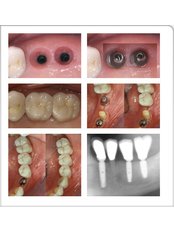 Implant Dentist Consultation - Dr. Luiz Alberto Ferraz de Caldas