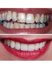 Dental Crowns - Dr. Luiz Alberto Ferraz de Caldas