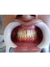 Dental Crowns - Dr. Priscila Barreto