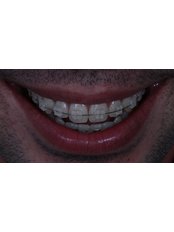 Consulta odontológica / Dentist Consultation - Prof. Dr. Rowan Vilar - Dental Implants and Venners Specialist