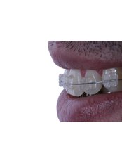 BriteSmile™ Teeth Whitening - Prof. Dr. Rowan Vilar - Dental Implants and Venners Specialist