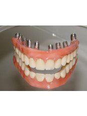 Dental Implants - SB Specialized Dental Office Brazil
