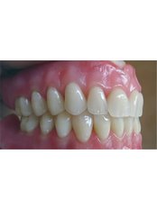 Dentures - SB Specialized Dental Office Brazil