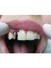 Dental Implants - Amaya Dental Clinic