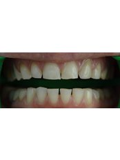 Veneers - Amaya Dental Clinic
