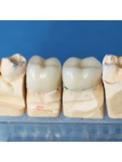 Dental Crowns - BG Denta