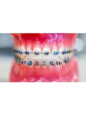 Child Braces - Dental Clinic Sofia Crown