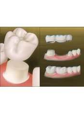 Dental Crowns - Dental Clinic Sofia Crown