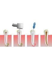 Root canals - Dental Clinic Sofia Crown