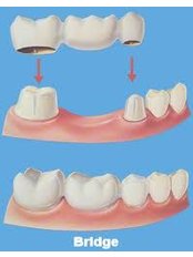 Dental Bridges - Dental Clinic Sofia Crown