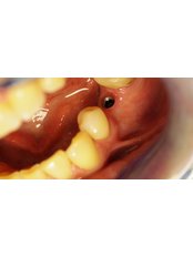 Implant Dentist Consultation - iDENTAL