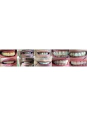 Porcelain Crown - Medstom Dental Clinic Dondukov