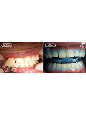 Laser Teeth Whitening - Medstom Dental Clinic Dondukov
