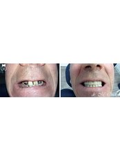 Zirconia Crown - Medstom Dental Clinic Dondukov