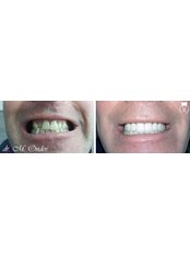 Zirconia Crown - Medstom Dental Clinic Stambolov