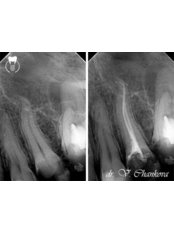 Complex Root Canal Treatment - Medstom Dental Clinic Stambolov