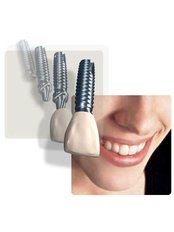 Dental Implants - Ribagin Dent