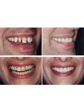 Dental Bonding - Ribagin Dent
