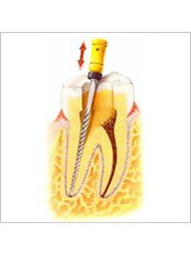 Molar Root Canal - Ribagin Dent