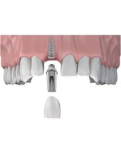 Single Implant - Ribagin Dent