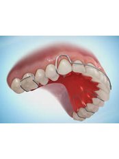Orthodontic Retainer - Ribagin Dent