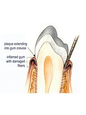 Gingivitis Treatment - Ribagin Dent