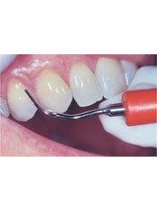 Ultrasonic Scaling - Ribagin Dent
