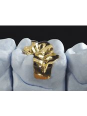 Gold Inlay or Onlay - Ribagin Dent