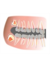 Wisdom Tooth Extraction - Ribagin Dent