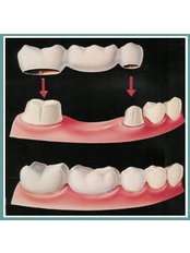 Dental Bridges - Ribagin Dent