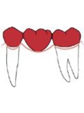Fixed Partial Dentures - Ribagin Dent