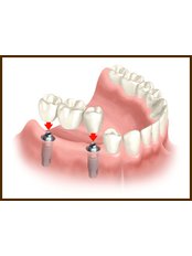 Implant Bridge - Ribagin Dent