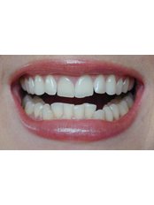 Teeth Contouring and Reshaping - Ribagin Dent