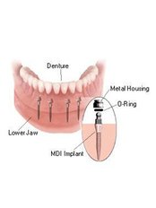 Mini Implants - Ribagin Dent