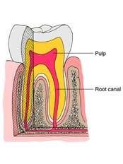 Single Visit Root Canal - Ribagin Dent