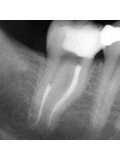 Root canals - Ribagin Dent