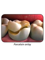 Porcelain Inlay or Onlay - Ribagin Dent