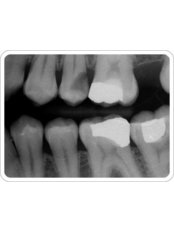 Traditional Dental X-Ray - Ribagin Dent