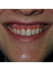 Gum Surgery - Ribagin Dent