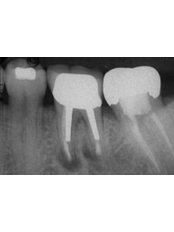 Root End Surgery - Ribagin Dent