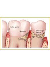 Scaling and Root Planing - Ribagin Dent