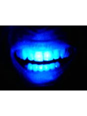 Laser Teeth Whitening - Ribagin Dent