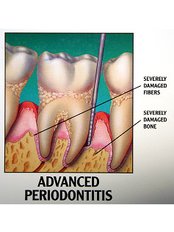 Periodontitis Treatment - Ribagin Dent