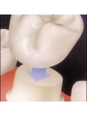 Dental Crowns - Ribagin Dent