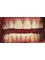 Vedra Dental 24/7 Holistic Clinic - 4 Veneers +3weeks 