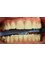 Vedra Dental 24/7 Holistic Clinic - Cemented 4 upper front Veneers 